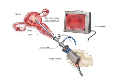 Vaginal Endoscopy